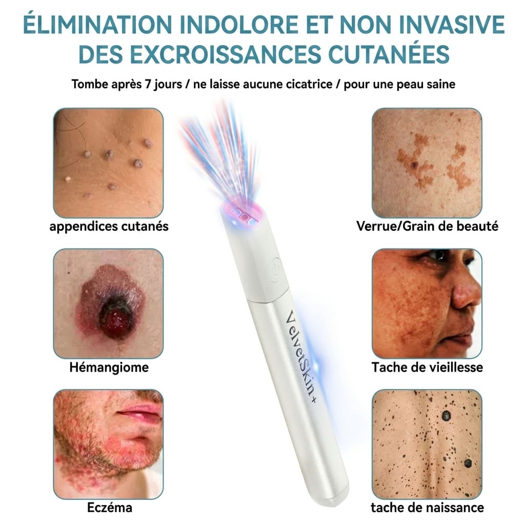 Stylo laser pour l'élimination des grains de beauté et des verrues - 30$
