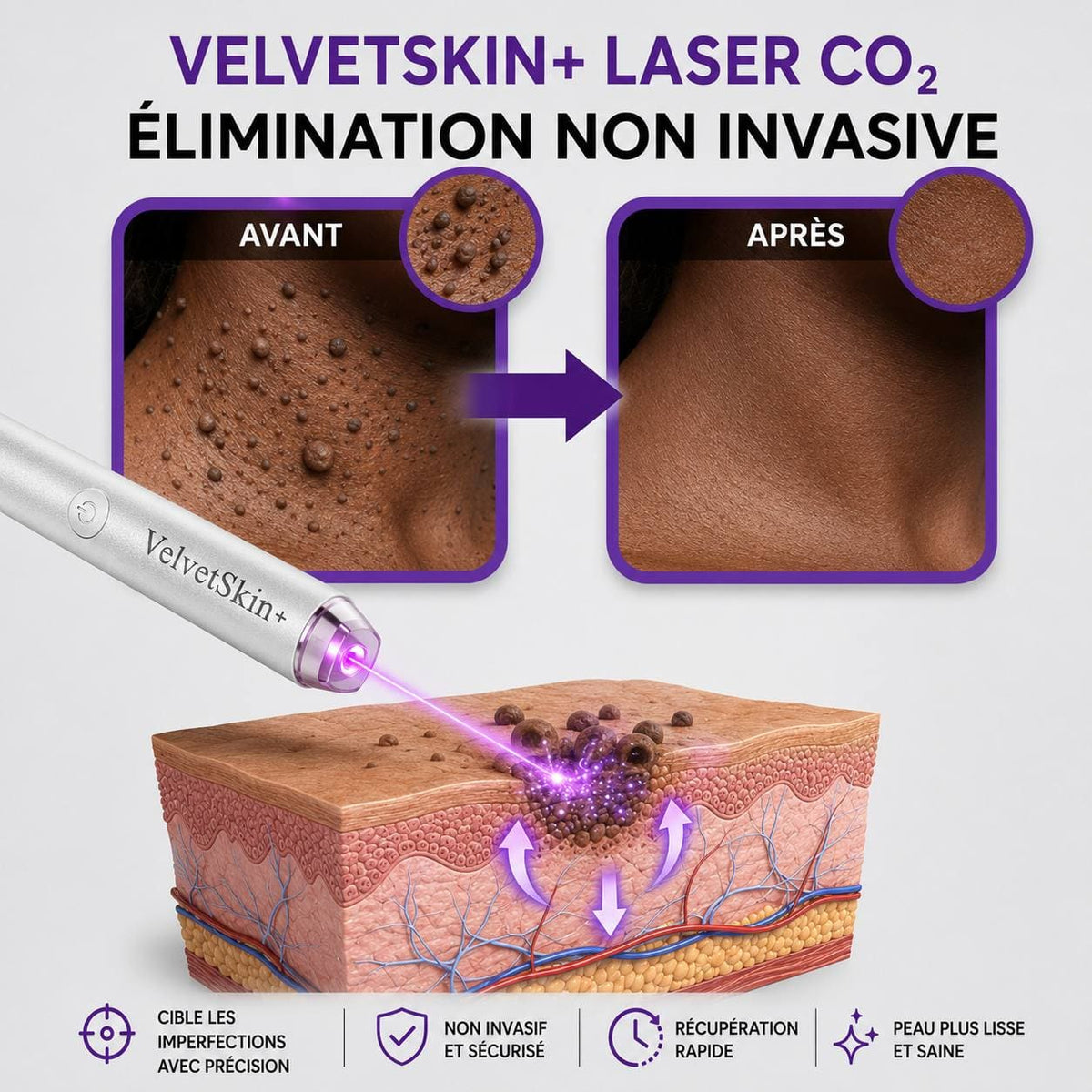 Stylo laser pour l'élimination des grains de beauté et des verrues - 30$