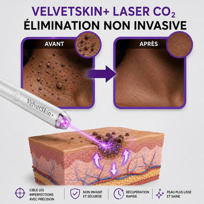 Stylo laser pour l'élimination des grains de beauté et des verrues - 30$