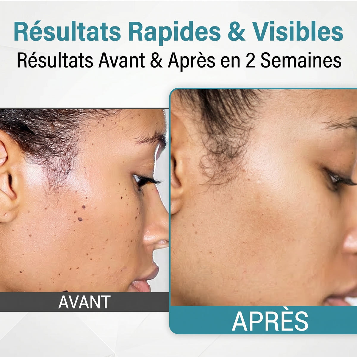 Stylo laser pour l'élimination des grains de beauté et des verrues - 30$