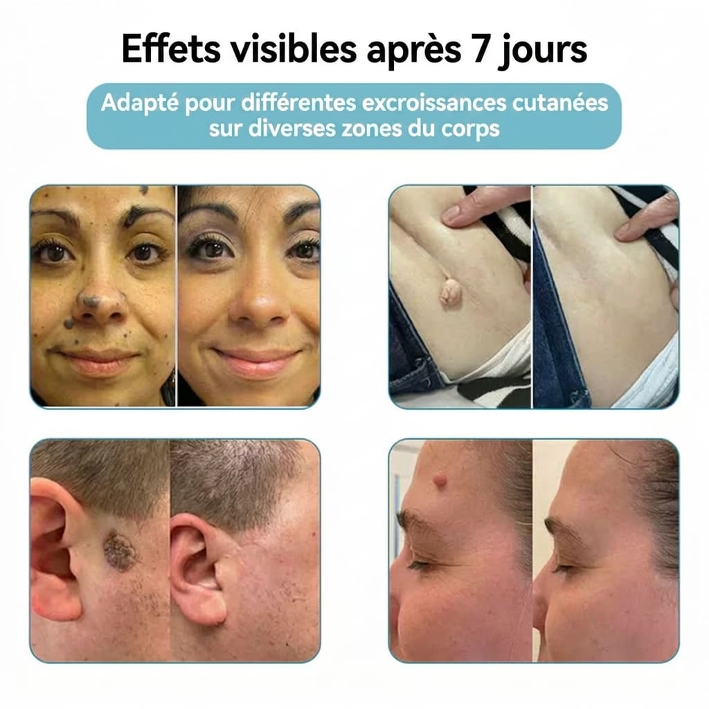 Stylo laser pour l'élimination des grains de beauté et des verrues - 30$