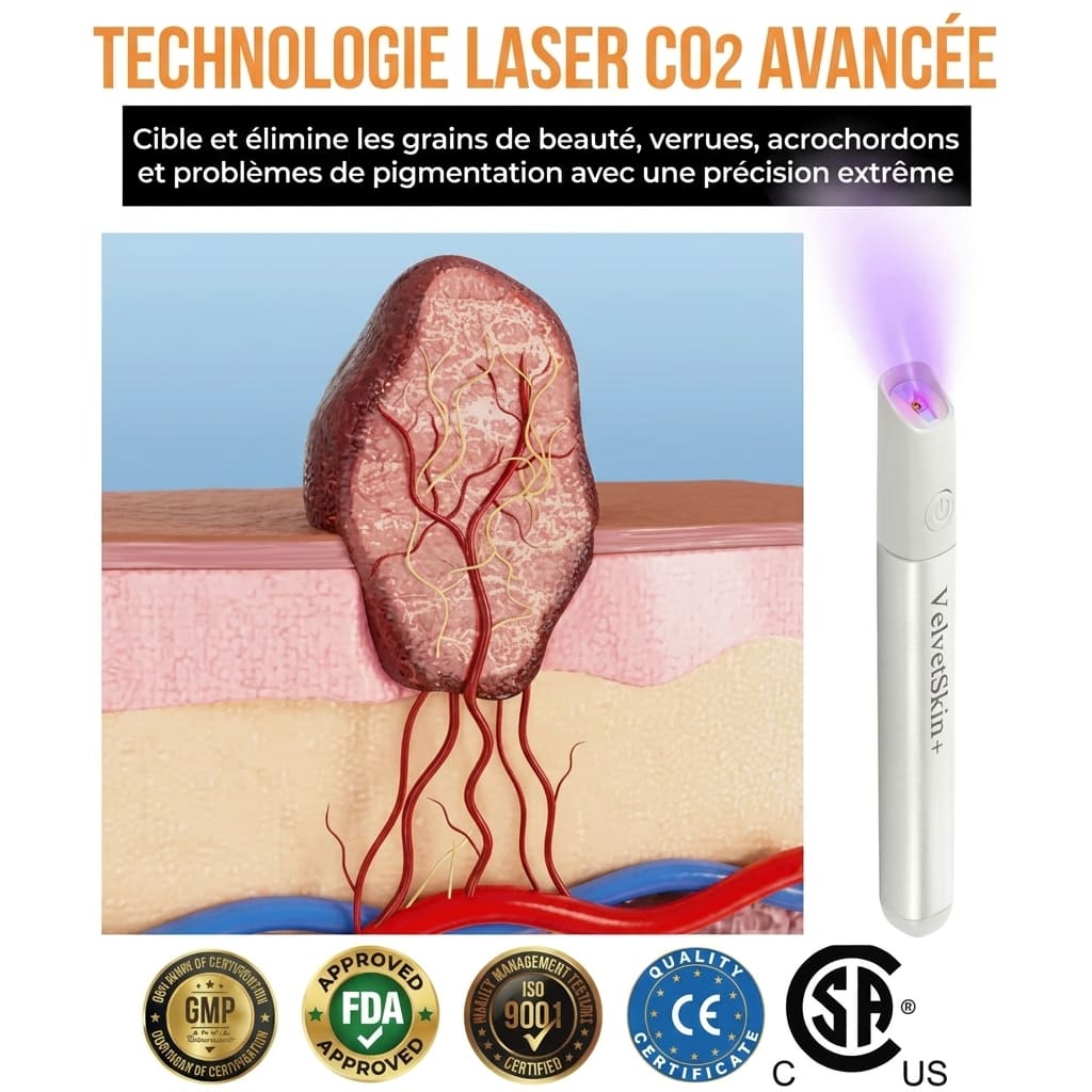 Stylo laser pour l'élimination des grains de beauté et des verrues - 30$